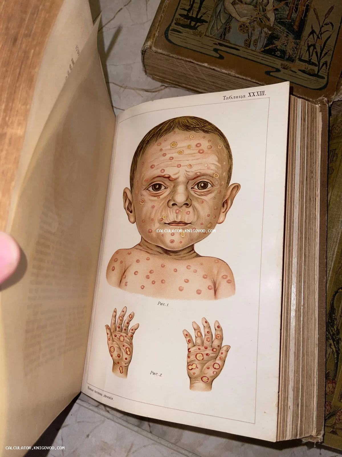 Разворот старинной книги с цветной литографией, изображающей ребенка и руки с кожными поражениями. Текст на русском: Таблица XXXIII.